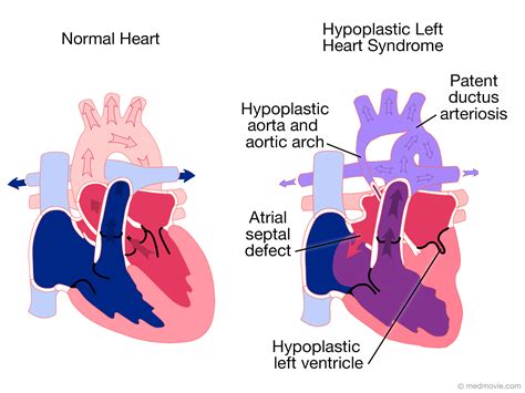 hypoplastic lv|hypoplastic left heart syndrome adult.